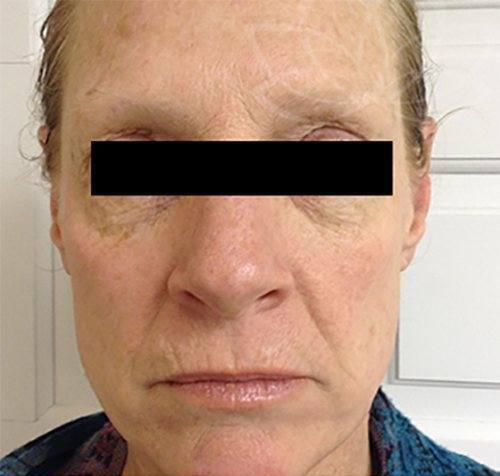 Photofacial Before & After Image