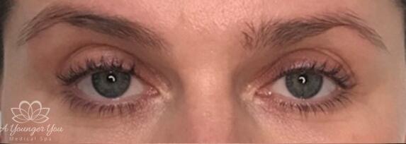 HydraFacial Before & After Image