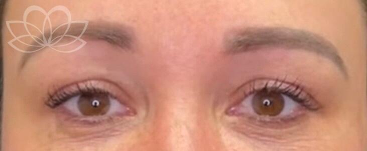 HydraFacial Before & After Image